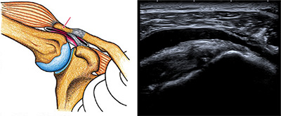 インピンジメント症候群