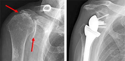 変形性肩関節症
